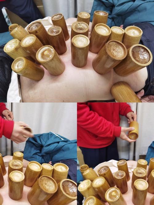 怎样拔罐视频2026