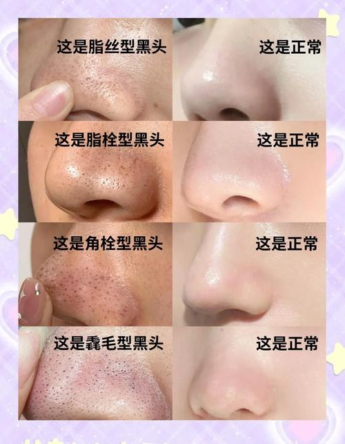 清除黑头视频2026