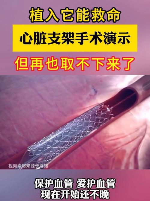 心脏支架手术视频2026